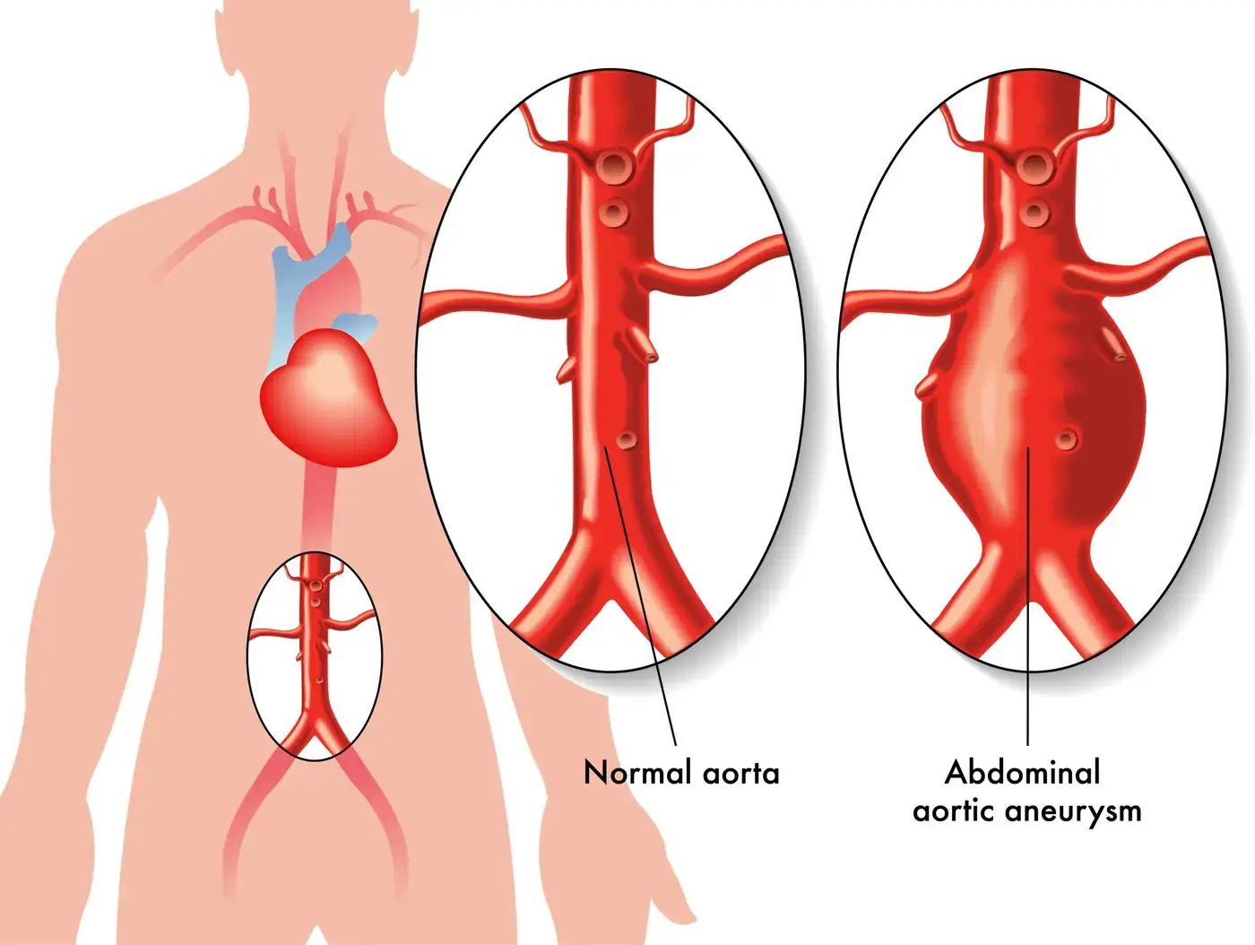 Medical,Illustration,Of,The,Effects,Of,Abdominal,Aortic,Aneurysm.