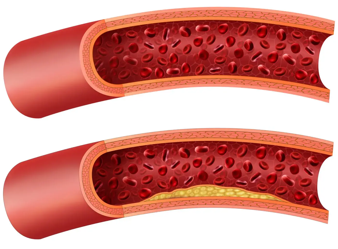 Preventive Cardiovascular Screening