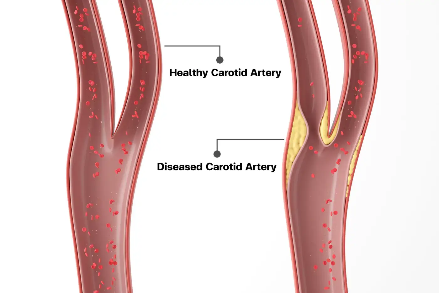 Carotid Artery Ultrasound Screening